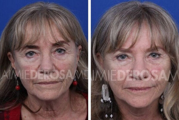 Clients beautiful before and after brow lift results.