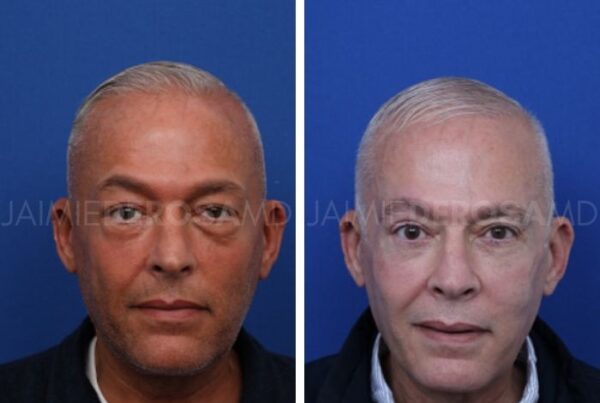 Successful before and after photo for clients eyelid surgery.