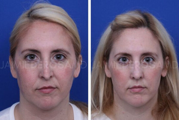 Client before and after for revision rhinoplasty.