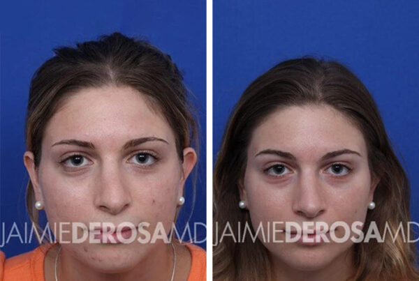 Client before and after photo for rhinoplasty.