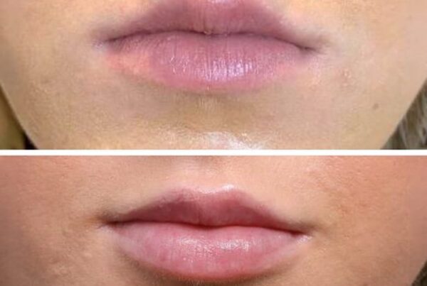 Patient lip filler before and after photos showing fuller, more defined lips at DeRosa Center in Boston, MA